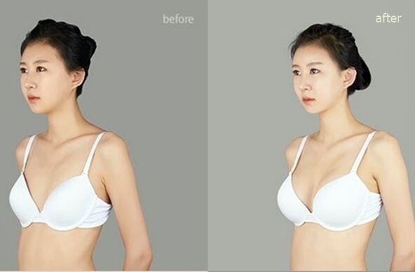 przed i po plastycznym powiększeniu piersi