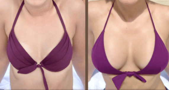 Przed i po operacji powiększenia piersi