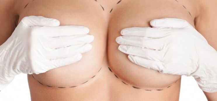 powiększenie piersi metodą operacyjną