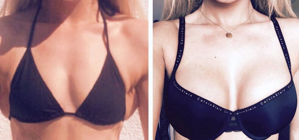 Przed i po powiększeniu piersi